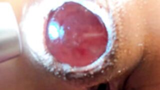 Fucking her prolapse