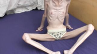 anorexic Denisa 28-12-2020