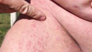 Allergie entre les jambes, Noel Lauffenburger