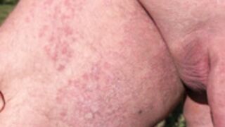Allergie entre les jambes, Noel Lauffenburger