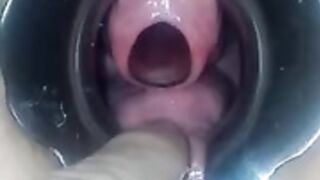 peehole insertion