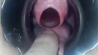 peehole insertion