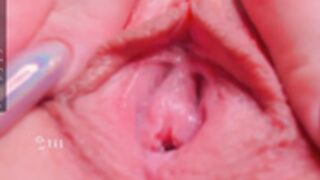 ElsieFoster, rgo_tonsy_2 2022-03-31