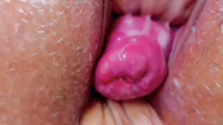 Cervix Prolapse