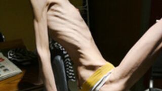 anorexic Denisa 8t00090